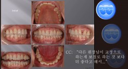 교정 Case 719.  비대칭 발치, U2U5L1 발치, Sem #13.0 & #13.2