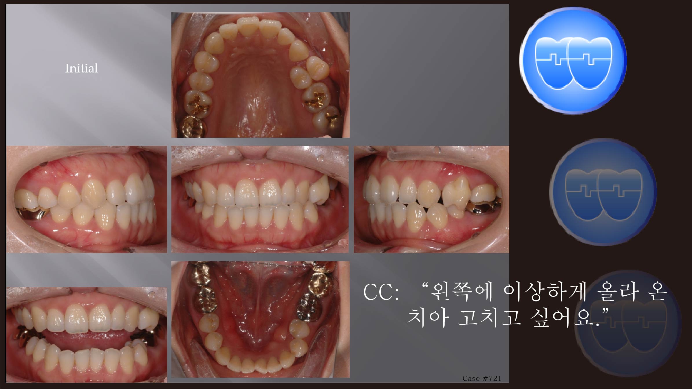 교정 Case 721.  24번 발치 Only, 비대칭 발치, Upper Midline Correction, Sem #13.2