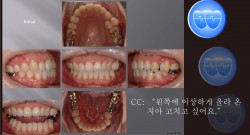 교정 Case 721.  24번 발치 Only, 비대칭 발치, Upper Midline Correction, Sem #13.2