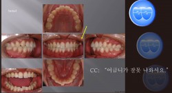 교정 Case 722.  비발치, Bilateral Posterior Scissor bite, Sem #7.8