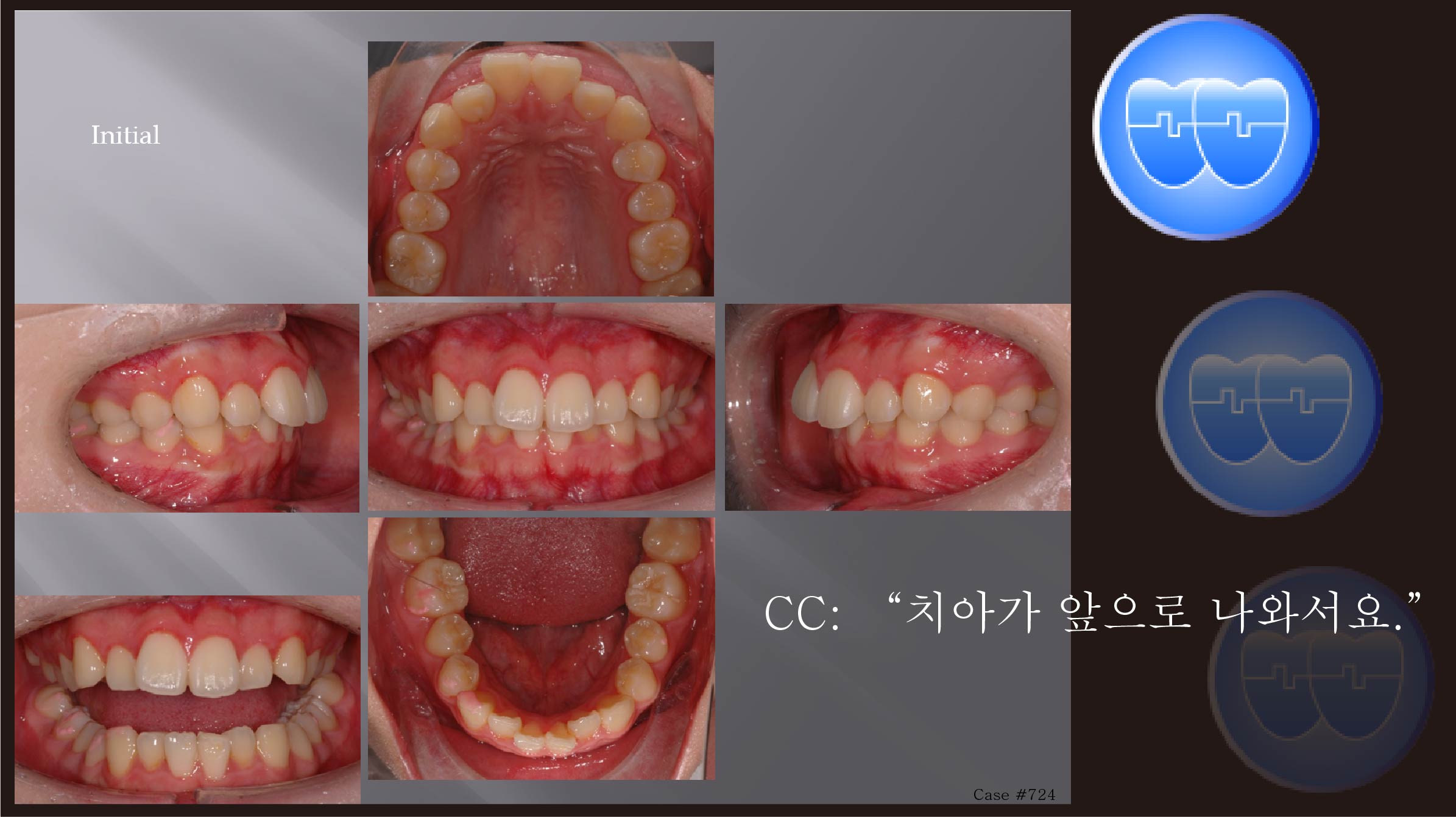 교정 Case 724.  U5 발치, Deepbite, Bracket Error, Prominent Chin, Sem #17