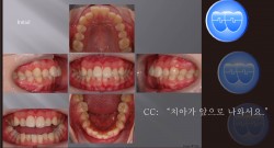 교정 Case 724.  U5 발치, Deepbite, Bracket Error, Prominent Chin, Sem #17