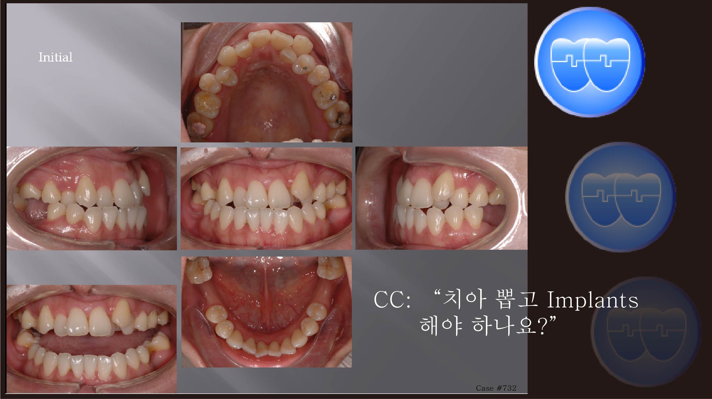 교정 Case 732.  U7 발치, Skeletal Class III, Proclined Upper Incisors, Molar Substitution, Prosth-Ortho., Sem #13.3