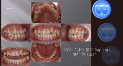 교정 Case 732.  U7 발치, Skeletal Class III, Proclined Upper Incisors, Molar Substitution, Prosth-Ortho., Sem #13.3