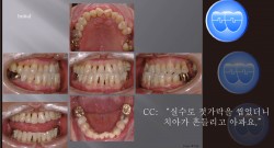 교정 Case 749.  비발치, 성인, Perio-Ortho, Prosth-Ortho., Class III, Sem #20