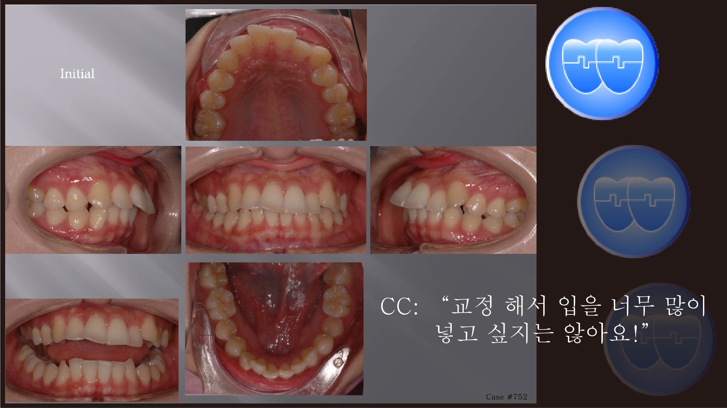 교정 Case 752.  U5 발치, Deepbite, Sem #6