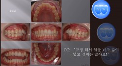 교정 Case 752.  U5 발치, Deepbite, Sem #6