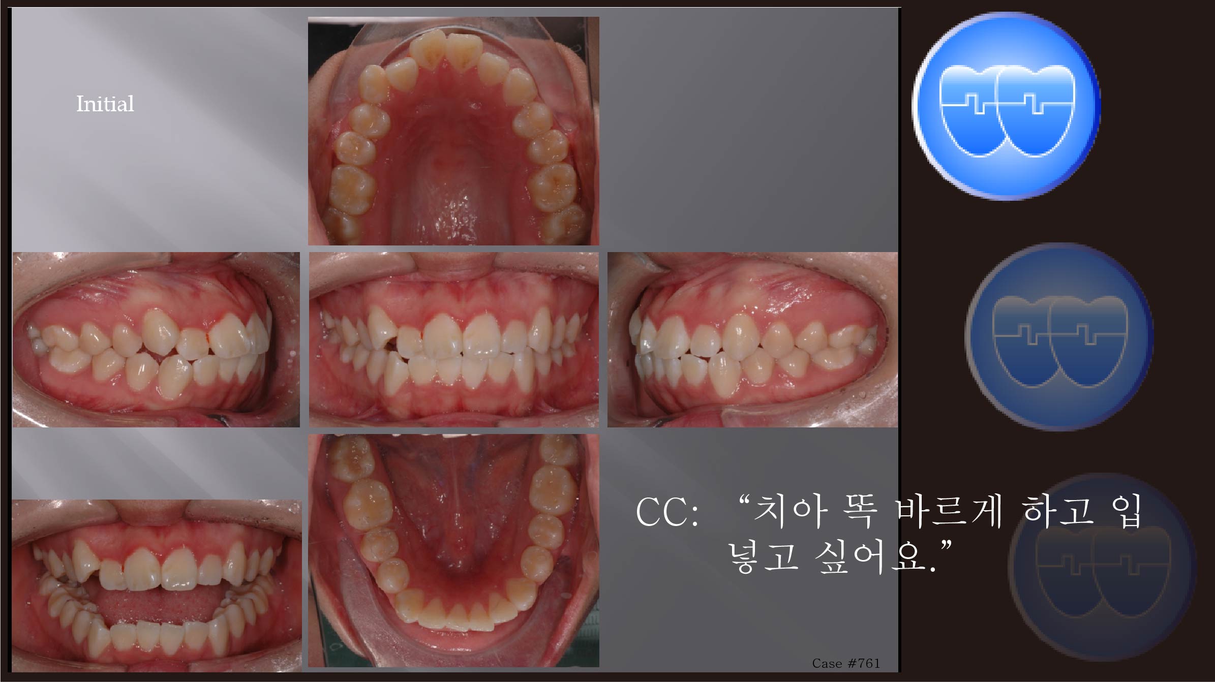 교정 Case 761.  U5L4 발치, Relapse(Bite Open), Unexpected Resistance, Lower Lingual Corticotomy, Sem #13.7