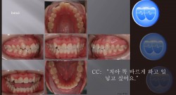 교정 Case 761.  U5L4 발치, Relapse(Bite Open), Unexpected Resistance, Lower Lingual Corticotomy, Sem #13.7