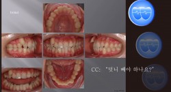 교정 Case 762.  U5L5 발치, Gingival Recession, Sem #12.4