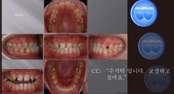 교정 Case 769.  U2L4 발치, Anterior Crossbite, Congenital Missing of #12, #22, Sem #13