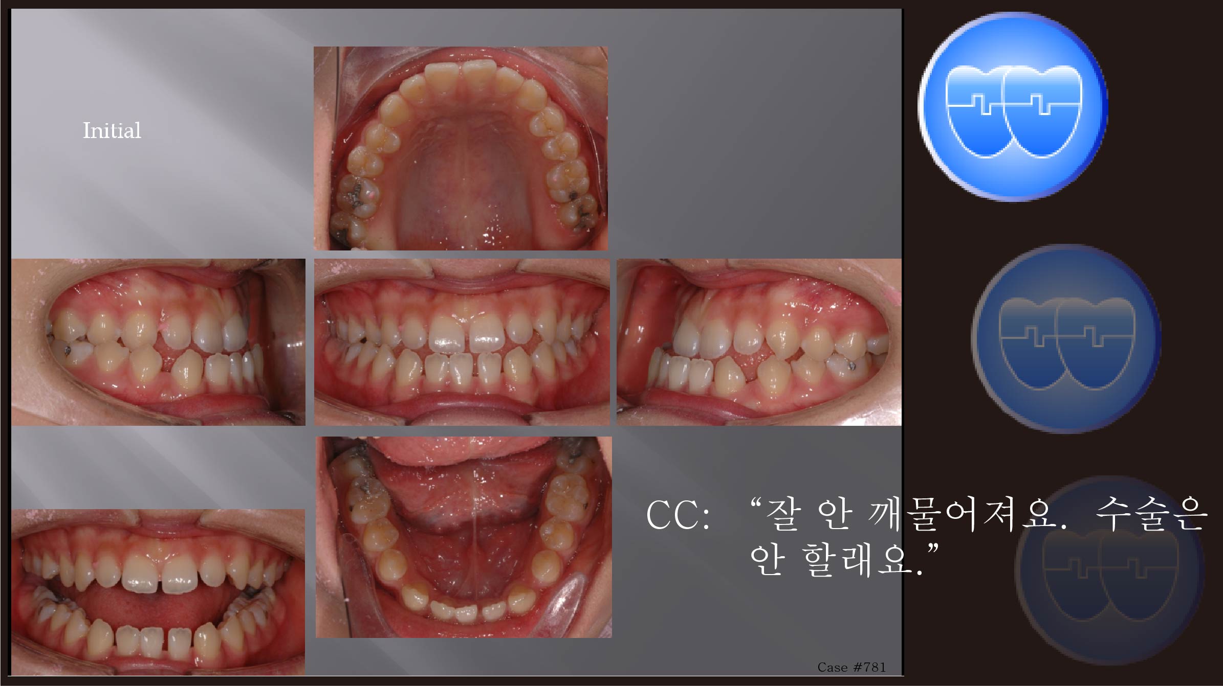 교정 Case 781.  L1 Missing, Class III, Lower Lingual Corticotomy, Sem #7