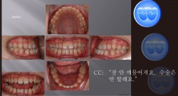 교정 Case 781.  L1 Missing, Class III, Lower Lingual Corticotomy, Sem #7