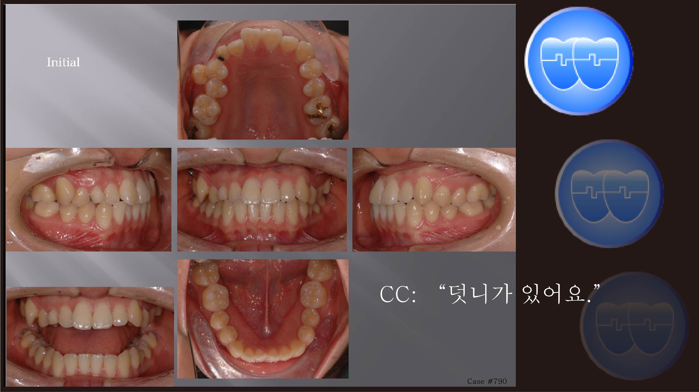 교정 Case 790.  비대칭 발치 (14,25,34,44 발치), Ectopic Eruption, Sem #13.2