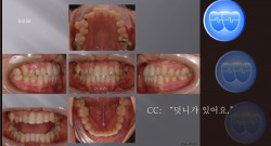 교정 Case 790.  비대칭 발치 (14,25,34,44 발치), Ectopic Eruption, Sem #13.2