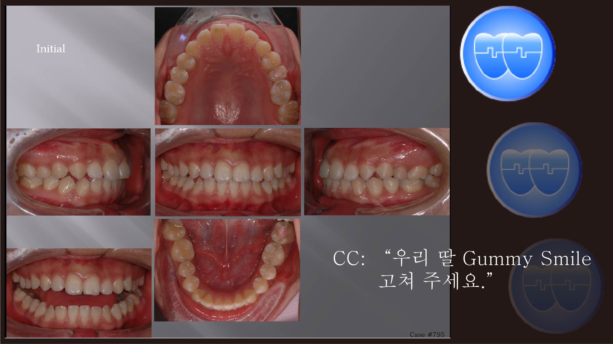 교정 Case 795. 비발치, Gummy Smile, Upper Occlusal Table Intrusion, Miniscrew 뿌리 손상, Sem #5.5