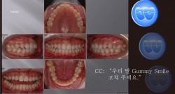 교정 Case 795. 비발치, Gummy Smile, Upper Occlusal Table Intrusion, Miniscrew 뿌리 손상, Sem #5.5