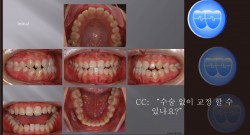 교정 Case 805.  L4 발치, Openbite, Lower Lingual Corticotomy, Sem #7