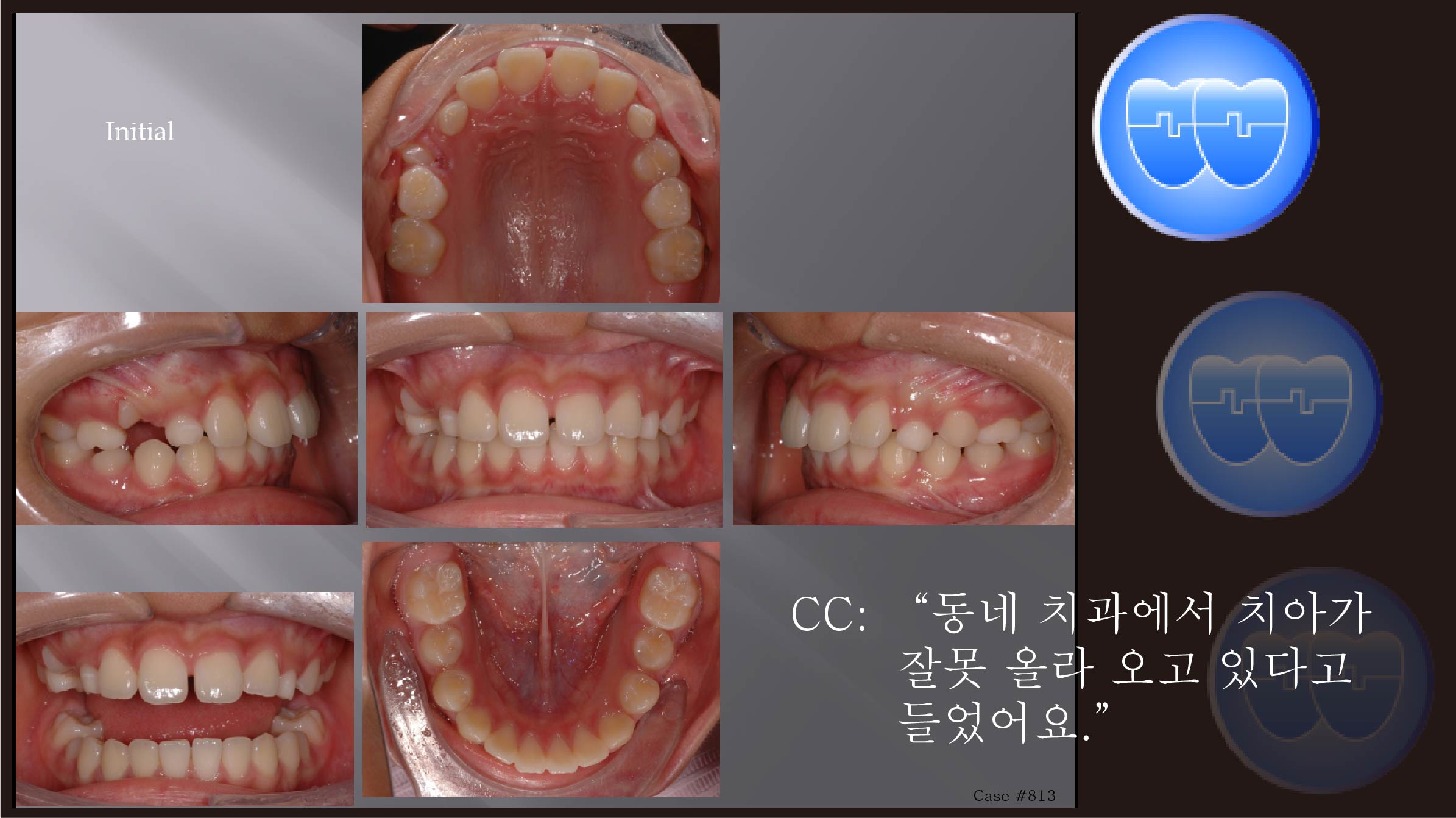 교정 Case 813.  Impacted #23, Ectopic Eruption, 비대칭 발치, Sem #14