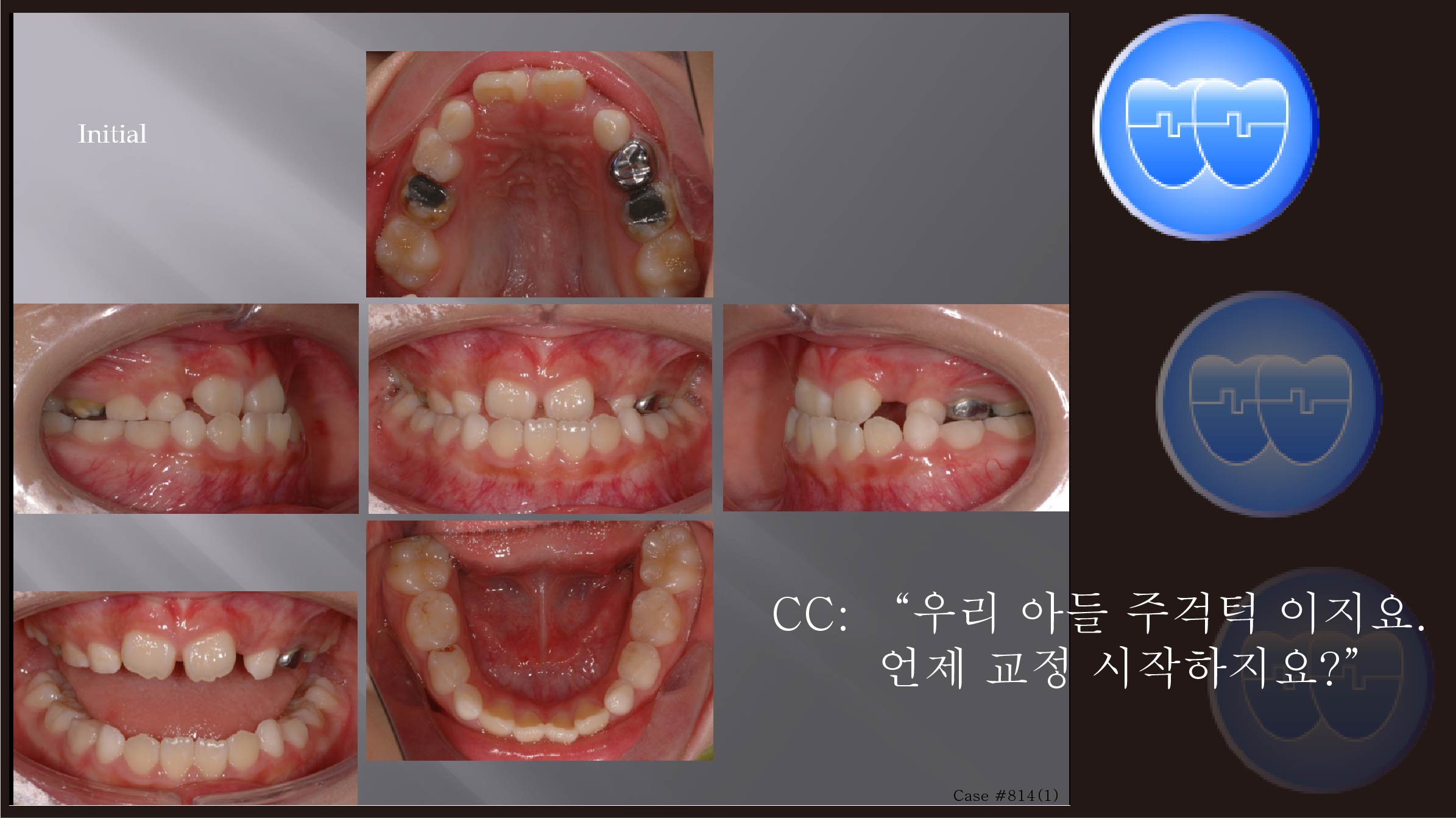 교정 Case 814(1).  1차 교정, Anterior Crossbite, Posterior Crossbite, Class III, Sem #9