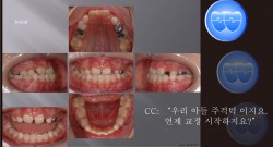 교정 Case 814(1).  1차 교정, Anterior Crossbite, Posterior Crossbite, Class III, Sem #9