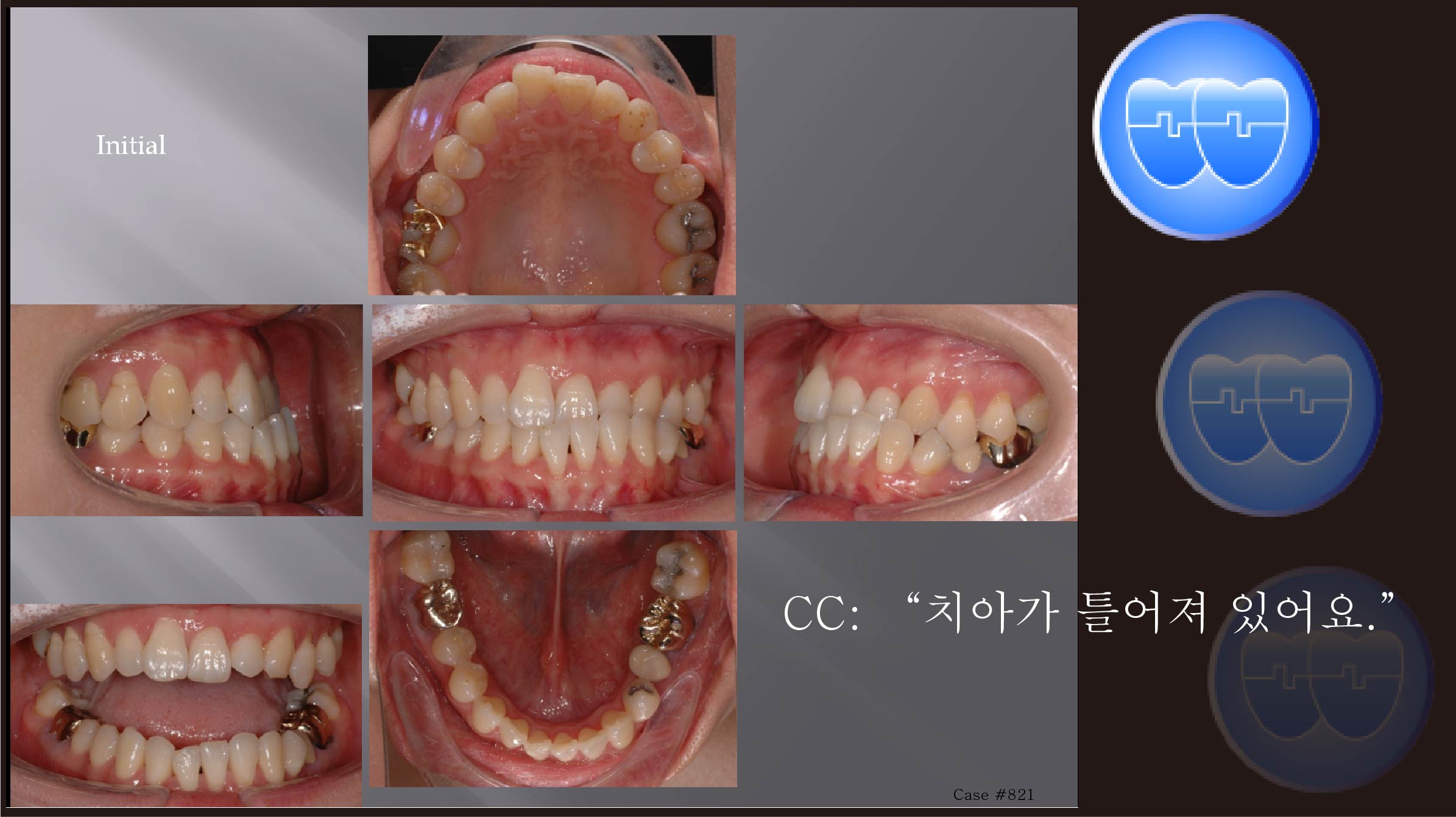 교정 Case 821.  비발치, Tilted Occlusal Table, Anterior Crossbite, Functional Shift, Lower Lingual Corticotomy, Sem #7.7