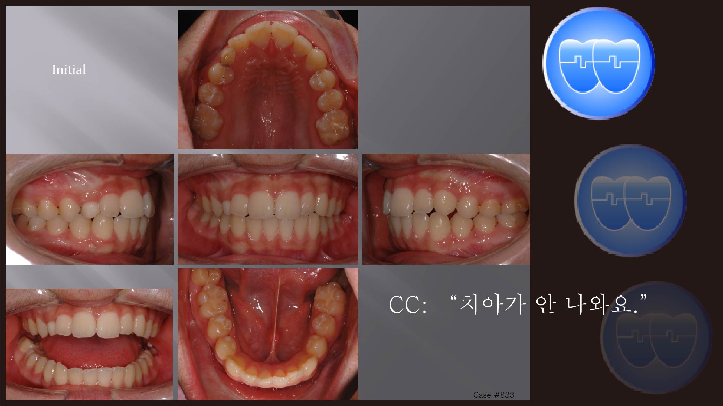 교정 Case 833.  비발치, Impaction of #13, Sem #14