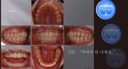 교정 Case 833.  비발치, Impaction of #13, Sem #14