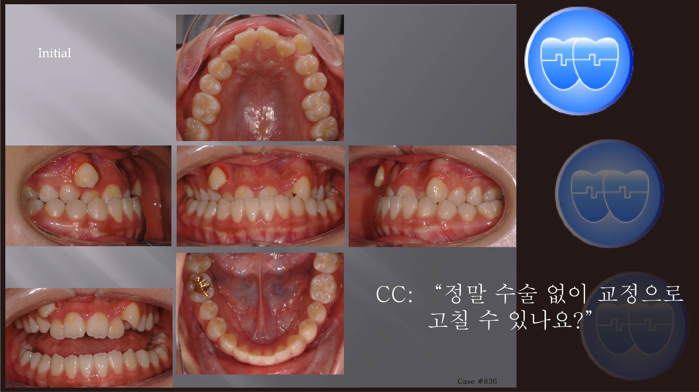 교정 Case 836.  U4L4 발치, Bonded RPE, Anterior and Posterior Crossbite, Lower Lingual Corticotomy, Sem #7.8