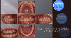 교정 Case 836.  U4L4 발치, Bonded RPE, Anterior and Posterior Crossbite, Lower Lingual Corticotomy, Sem #7.8