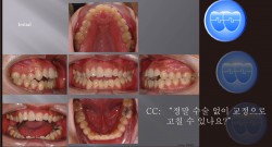 교정 Case 838.  U5L4 발치, Openbite, Lower Lingual Corticotomy, Sem #7