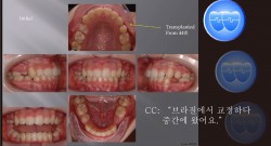 교정 Case 854.  U4L4 발치, 재교정, Transplantation하고 옴, Sem #12.1