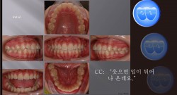 교정 Case 856.  U5L5 발치, Gummy Smile 가능성, 교정 중에 TMJ 소리(Grinding), Sem #7.5