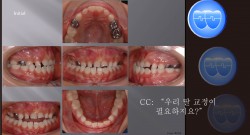 교정 Case 858.  1차 교정, Functional Shift, Anterior and Posterior Crossbite, Sem #9