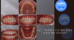 교정 Case 860.  L4 발치, Functional Shift, Lower Lingual Corticotomy, Sem #7.8