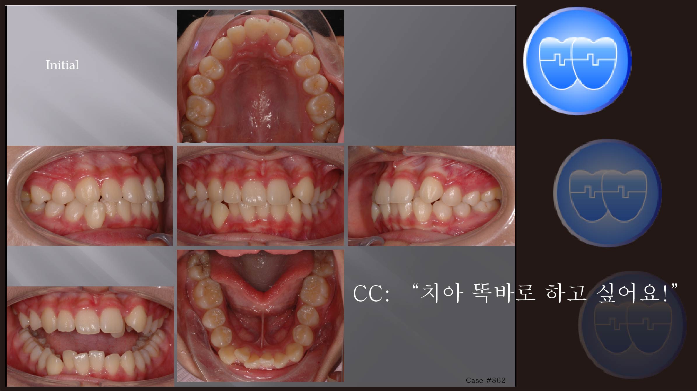 교정 Case 862.  U5L4 발치, Anterior Crossbite, Lower Crowding, Sem #12.3