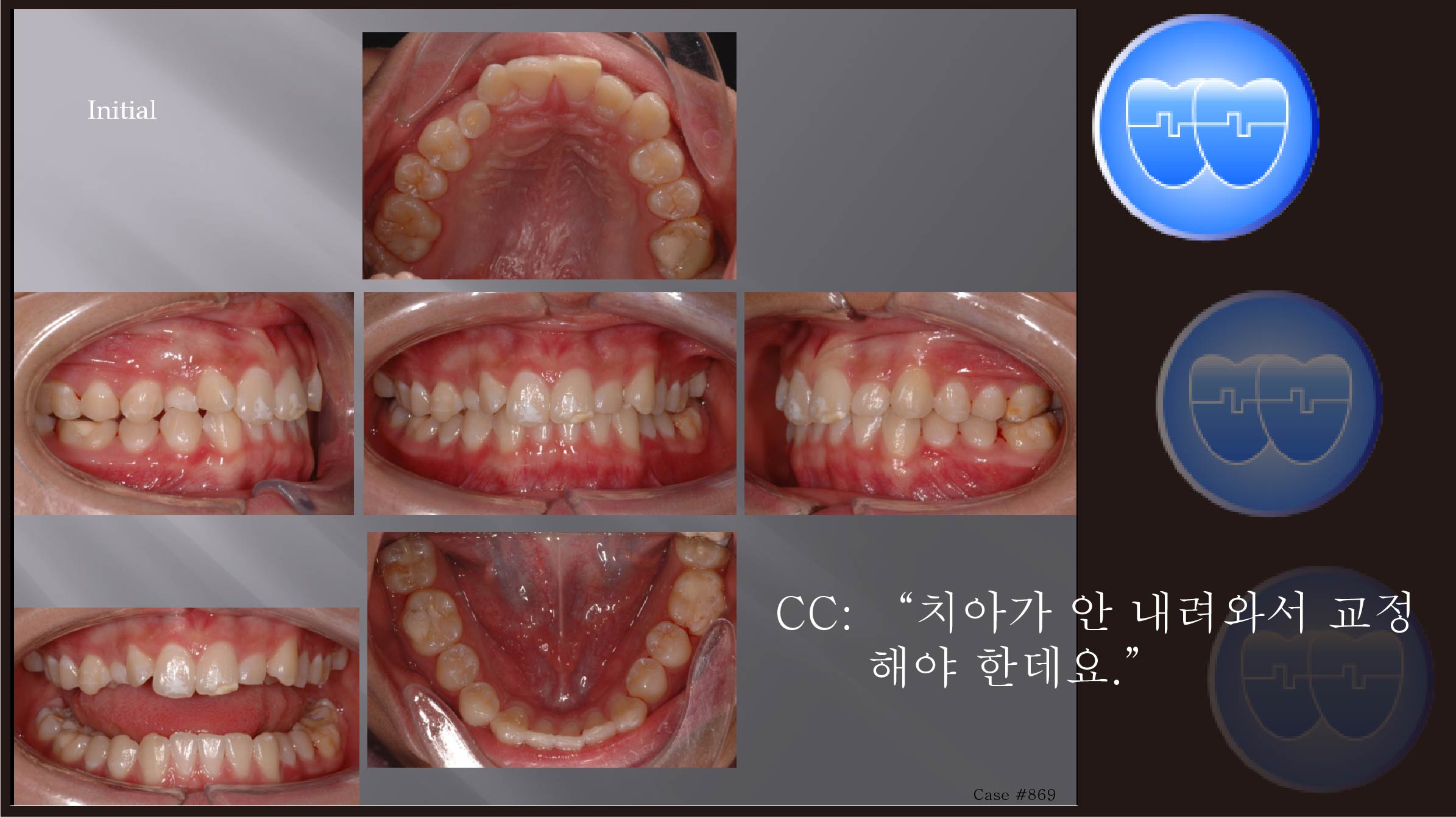 교정 Case 869.  비발치(L1 missing), Impacted Upper Canine, Root Resorption, Sem #14