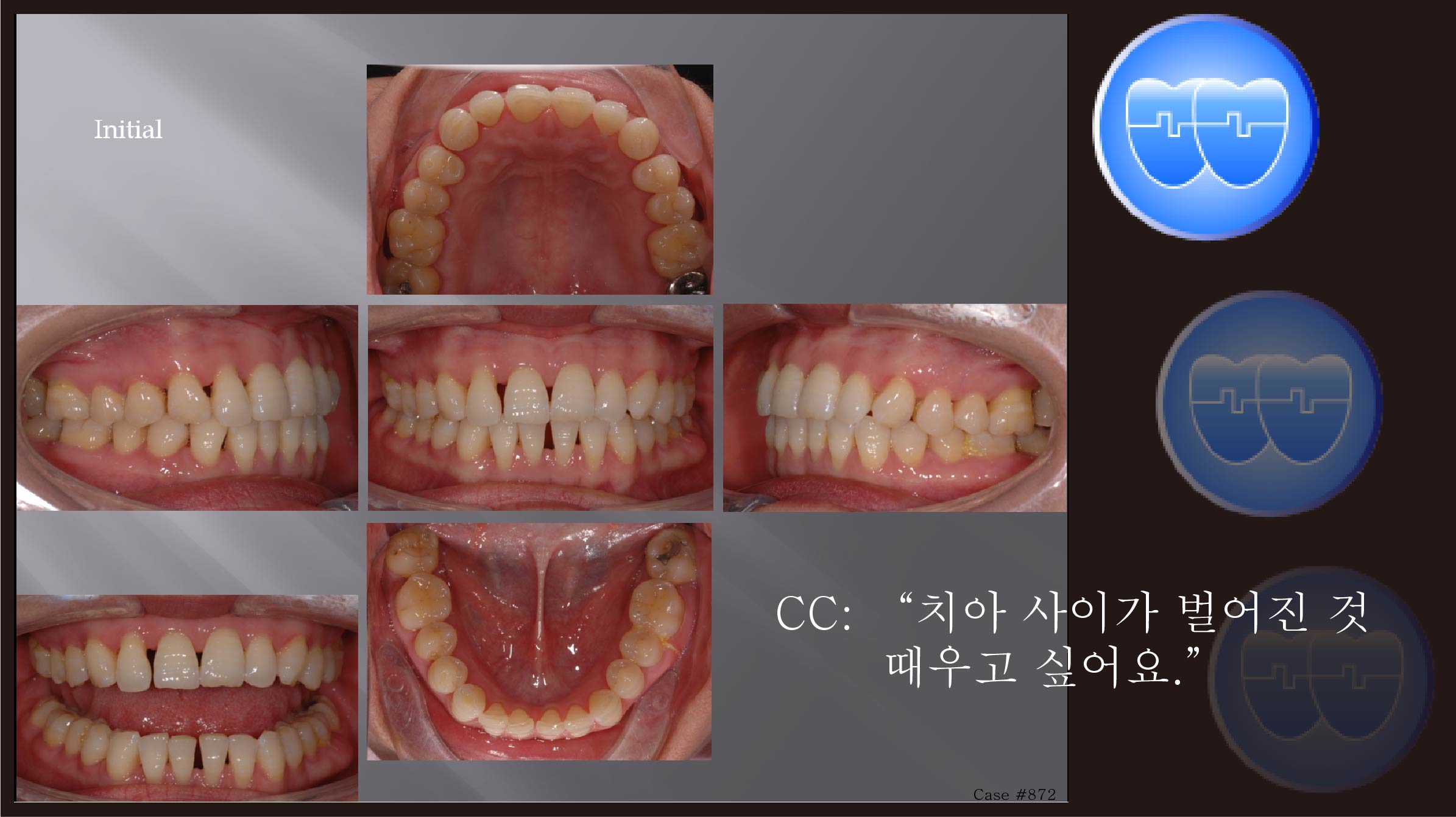 교정 Case 872.  부분교정, Anterior Space Problem, Sem #5