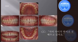 교정 Case 872.  부분교정, Anterior Space Problem, Sem #5