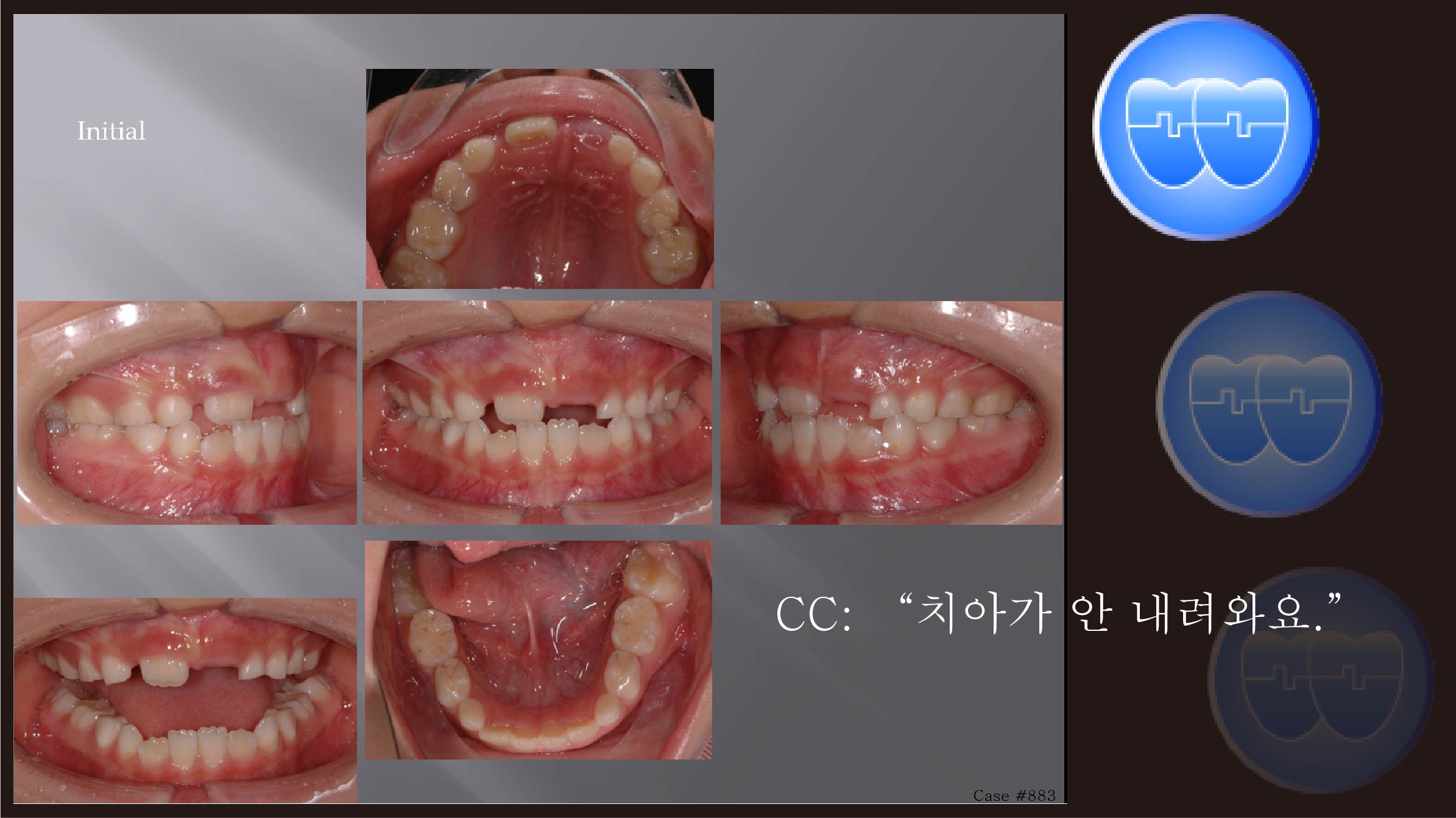 교정 Case 883.  1차 교정, Anterior Crossbite, Sem #9