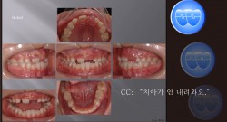 교정 Case 883.  1차 교정, Anterior Crossbite, Sem #9