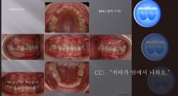 교정 Case 884.  1차 교정, RHG, Sem #9