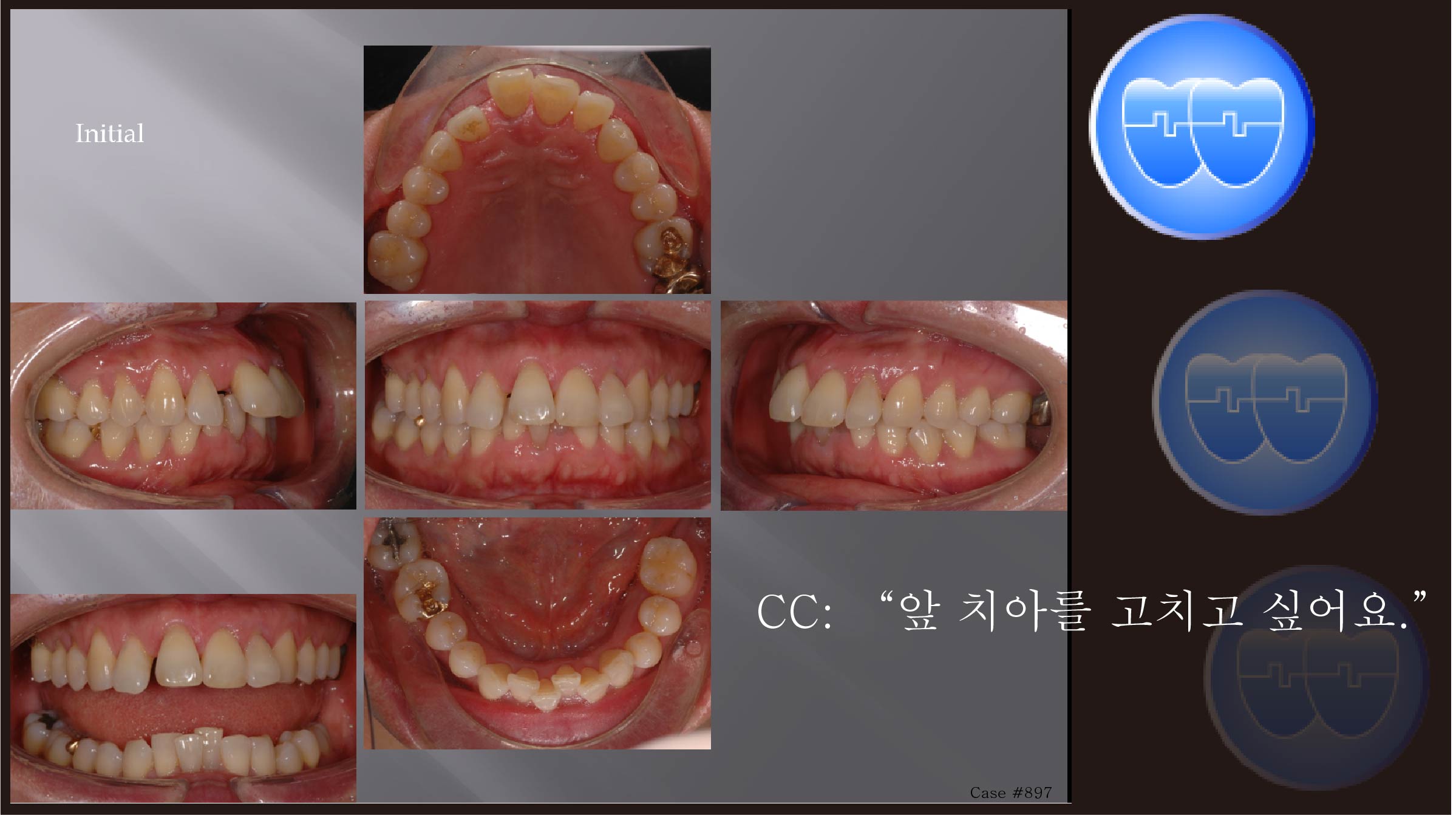 교정 Case 897.  비발치, 부분교정, Upper Diastomer, Perio Ortho., Sem #20