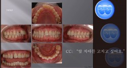 교정 Case 897.  비발치, 부분교정, Upper Diastomer, Perio Ortho., Sem #20