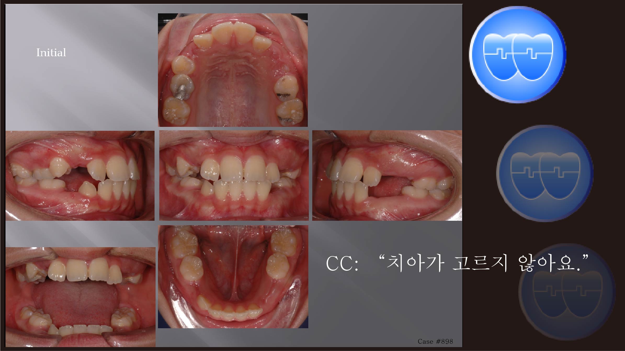 교정 Case 898.  비발치, Expansion, #37 Impaction, Sem #14