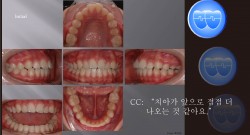 교정 Case 899.  U5 발치, Class II, Moderate Protrusion with Overjet, Sem #12.6