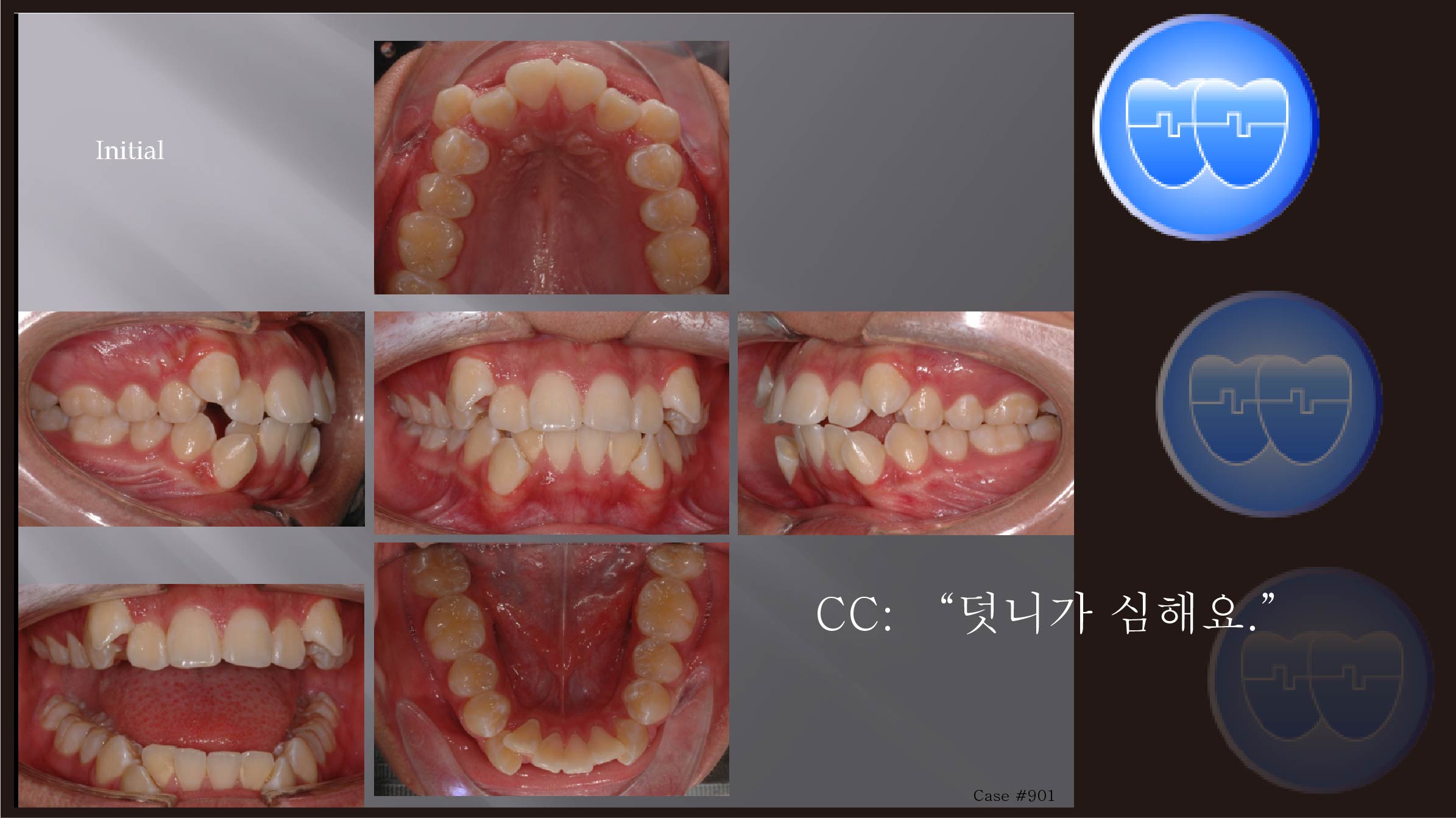 교정 Case 901.  U4L4 발치, Severe Crowding, Finishing with Wire Bending, Sem #12.1