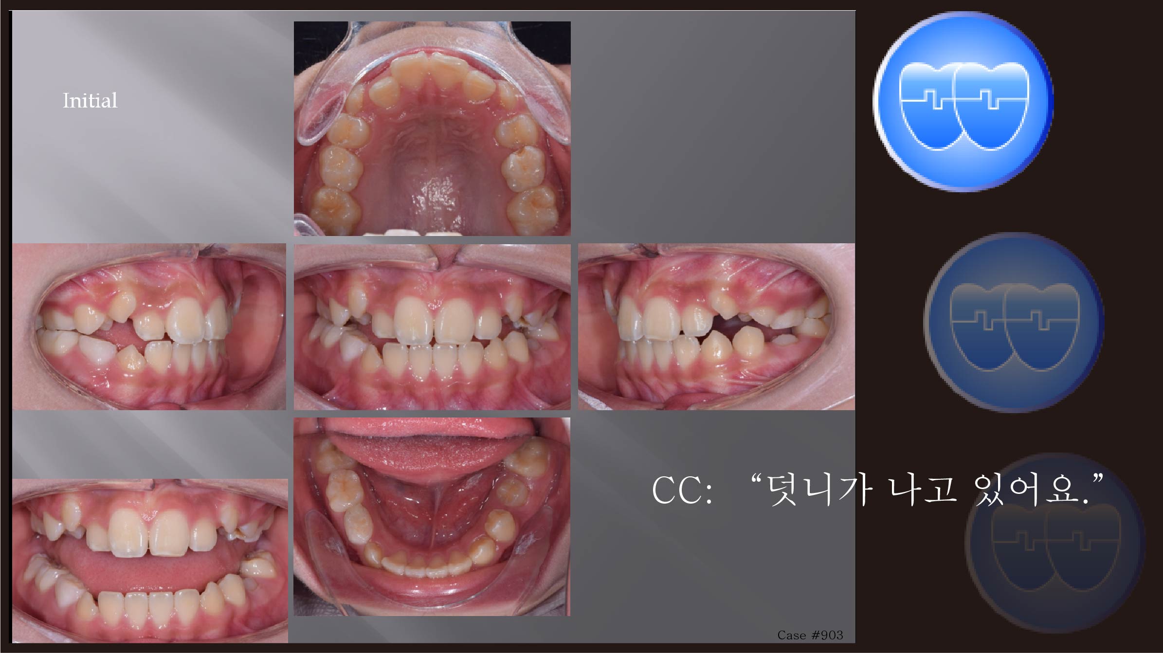 교정 Case 903.  비발치, Protrusion, Early DBS의 장점, Sem #11