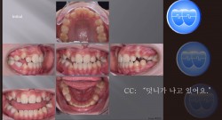 교정 Case 903.  비발치, Protrusion, Early DBS의 장점, Sem #11