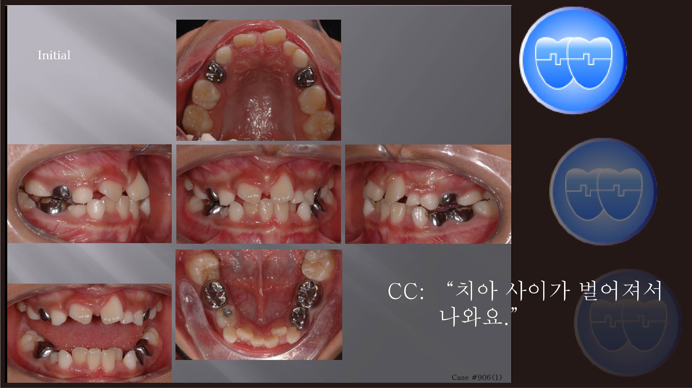 교정 Case 906(1).  1차 교정, #22 Congenital Missing, Impacted #46, Sem #9